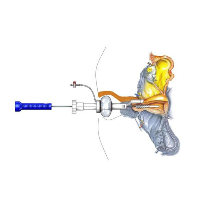 Uterine Manipulators